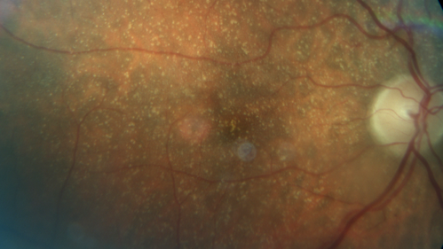 Unusual Intraretinal Deposits
71 year old diabetic man on dialysis with 20/20 vision and intraretinal deposits.  Recent 150 lb weight loss, on dialysis, see album properties for full history
