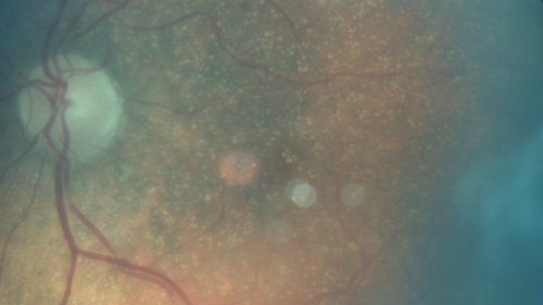 Unusual Intraretinal Deposits
71 year old diabetic man on dialysis with 20/20 vision and intraretinal deposits.  Recent 150 lb weight loss, on dialysis, see album properties for full history
