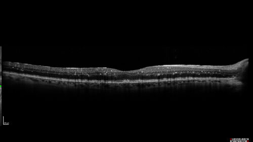 Unusual Intraretinal Deposits
71 year old diabetic man on dialysis with 20/20 vision and intraretinal deposits.  Recent 150 lb weight loss, on dialysis, see album properties for full history
