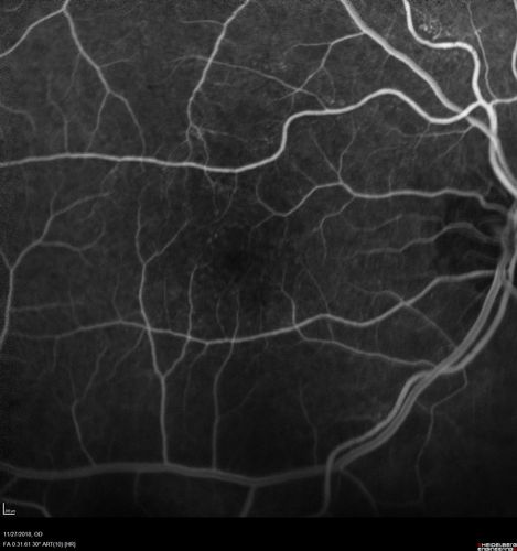 Unusual Intraretinal Deposits
71 year old diabetic man on dialysis with 20/20 vision and intraretinal deposits.  Recent 150 lb weight loss, on dialysis, see album properties for full history
