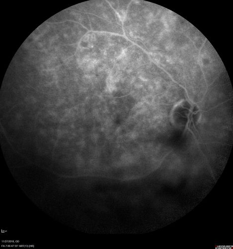 Unusual Intraretinal Deposits
71 year old diabetic man on dialysis with 20/20 vision and intraretinal deposits.  Recent 150 lb weight loss, on dialysis, see album properties for full history
