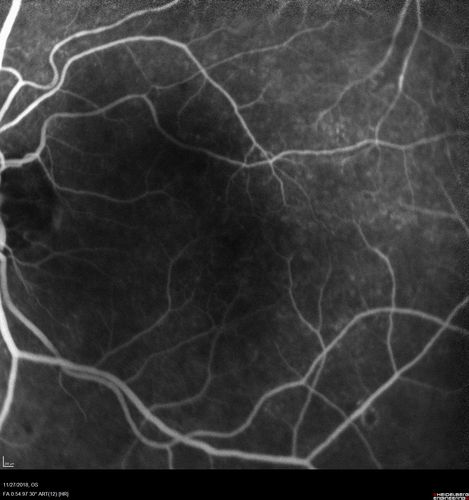 Unusual Intraretinal Deposits
71 year old diabetic man on dialysis with 20/20 vision and intraretinal deposits.  Recent 150 lb weight loss, on dialysis, see album properties for full history
