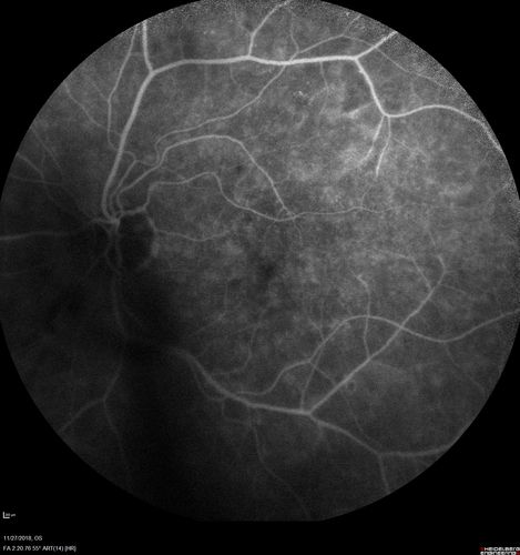 Unusual Intraretinal Deposits
71 year old diabetic man on dialysis with 20/20 vision and intraretinal deposits.  Recent 150 lb weight loss, on dialysis, see album properties for full history
