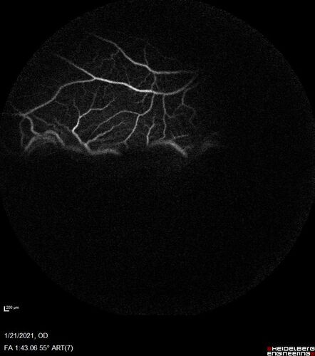 Massive subretinal hemorrhage right eye - polypoidal choroidal vasculopathy
Patient had sudden vision loss right eye.  Had vitrectomy.  The left eye had IPCV not responsive to avastin but he did respond to PDT.  See album notes for more detail.
