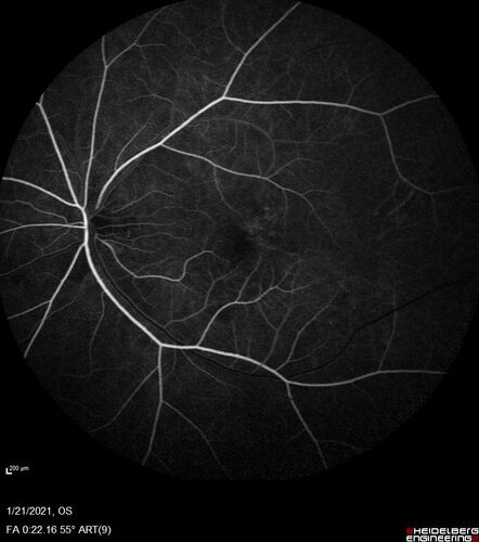 Massive subretinal hemorrhage right eye - polypoidal choroidal vasculopathy
Patient had sudden vision loss right eye.  Had vitrectomy.  The left eye had IPCV not responsive to avastin but he did respond to PDT.  See album notes for more detail.
