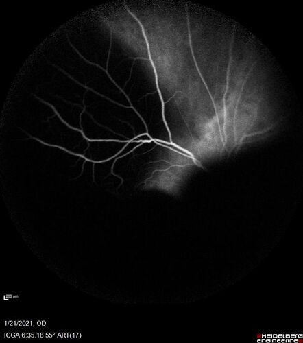 Massive subretinal hemorrhage right eye - polypoidal choroidal vasculopathy
Patient had sudden vision loss right eye.  Had vitrectomy.  The left eye had IPCV not responsive to avastin but he did respond to PDT.  See album notes for more detail.

