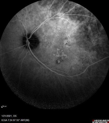 Massive subretinal hemorrhage right eye - polypoidal choroidal vasculopathy
Patient had sudden vision loss right eye.  Had vitrectomy.  The left eye had IPCV not responsive to avastin but he did respond to PDT.  See album notes for more detail.
