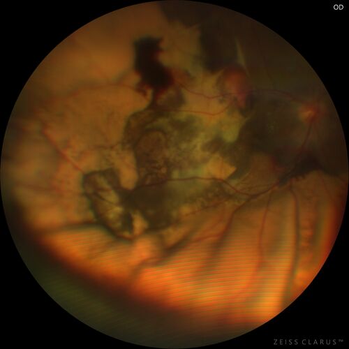 Massive subretinal hemorrhage right eye - polypoidal choroidal vasculopathy
Patient had sudden vision loss right eye.  Had vitrectomy.  The left eye had IPCV not responsive to avastin but he did respond to PDT.  See album notes for more detail.
