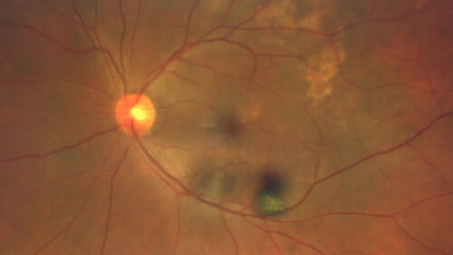 Massive subretinal hemorrhage right eye - polypoidal choroidal vasculopathy
Patient had sudden vision loss right eye.  Had vitrectomy.  The left eye had IPCV not responsive to avastin but he did respond to PDT.  See album notes for more detail.
