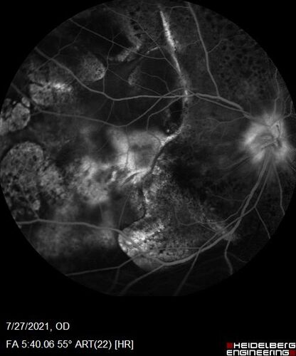 Massive subretinal hemorrhage right eye - polypoidal choroidal vasculopathy
Patient had sudden vision loss right eye.  Had vitrectomy.  The left eye had IPCV not responsive to avastin but he did respond to PDT.  See album notes for more detail.
