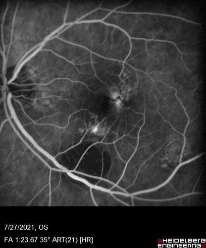 Massive subretinal hemorrhage right eye - polypoidal choroidal vasculopathy
Patient had sudden vision loss right eye.  Had vitrectomy.  The left eye had IPCV not responsive to avastin but he did respond to PDT.  See album notes for more detail.
