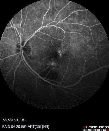 Massive subretinal hemorrhage right eye - polypoidal choroidal vasculopathy
Patient had sudden vision loss right eye.  Had vitrectomy.  The left eye had IPCV not responsive to avastin but he did respond to PDT.  See album notes for more detail.
