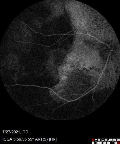 Massive subretinal hemorrhage right eye - polypoidal choroidal vasculopathy
Patient had sudden vision loss right eye.  Had vitrectomy.  The left eye had IPCV not responsive to avastin but he did respond to PDT.  See album notes for more detail.
