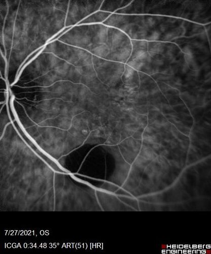 Massive subretinal hemorrhage right eye - polypoidal choroidal vasculopathy
Patient had sudden vision loss right eye.  Had vitrectomy.  The left eye had IPCV not responsive to avastin but he did respond to PDT.  See album notes for more detail.
