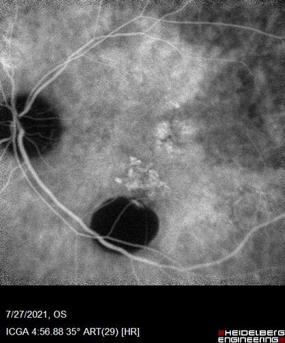 Massive subretinal hemorrhage right eye - polypoidal choroidal vasculopathy
Patient had sudden vision loss right eye.  Had vitrectomy.  The left eye had IPCV not responsive to avastin but he did respond to PDT.  See album notes for more detail.
