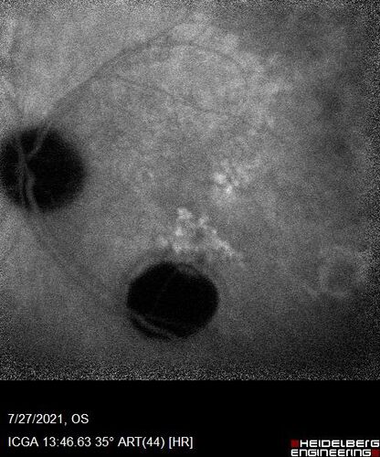 Massive subretinal hemorrhage right eye - polypoidal choroidal vasculopathy
Patient had sudden vision loss right eye.  Had vitrectomy.  The left eye had IPCV not responsive to avastin but he did respond to PDT.  See album notes for more detail.
