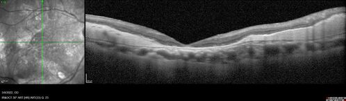 Massive subretinal hemorrhage right eye - polypoidal choroidal vasculopathy
Patient had sudden vision loss right eye.  Had vitrectomy.  The left eye had IPCV not responsive to avastin but he did respond to PDT.  See album notes for more detail.
