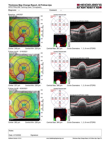 Massive subretinal hemorrhage right eye - polypoidal choroidal vasculopathy
Patient had sudden vision loss right eye.  Had vitrectomy.  The left eye had IPCV not responsive to avastin but he did respond to PDT.  See album notes for more detail.
