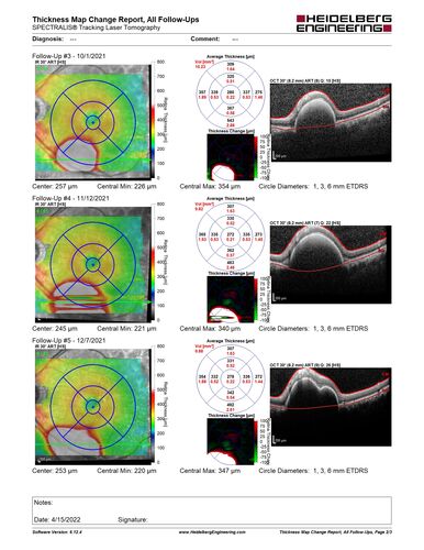 Massive subretinal hemorrhage right eye - polypoidal choroidal vasculopathy
Patient had sudden vision loss right eye.  Had vitrectomy.  The left eye had IPCV not responsive to avastin but he did respond to PDT.  See album notes for more detail.
