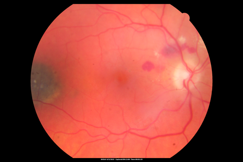 IPCV - idiopathic polypoidal choroidal vasculopathy - juxtapapillary CNVM with hemorrhage both eyes (also choroidal nevus right eye) - Subretinal hemorrhage both eyes
86 year old woman with shadow in vision OD and new hemmorhage OU.
