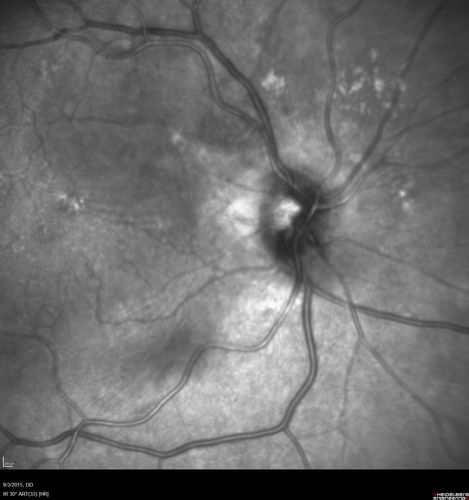 IPCV - idiopathic polypoidal choroidal vasculopathy - juxtapapillary CNVM with hemorrhage both eyes (also choroidal nevus right eye) - Subretinal hemorrhage both eyes
86 year old woman with shadow in vision OD and new hemmorhage OU.
