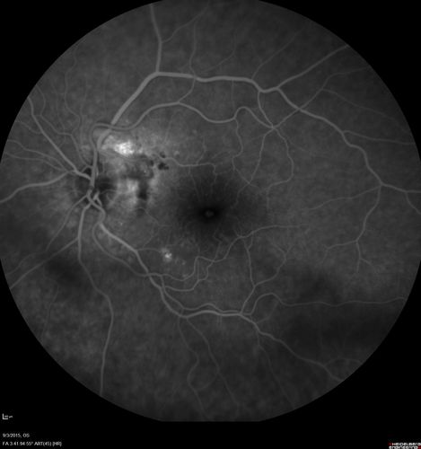 IPCV - idiopathic polypoidal choroidal vasculopathy - juxtapapillary CNVM with hemorrhage both eyes (also choroidal nevus right eye) - Subretinal hemorrhage both eyes
86 year old woman with shadow in vision OD and new hemmorhage OU.FA shows juxtapapillary CNVM
