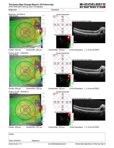 IPCV - idiopathic polypoidal choroidal vasculopathy - juxtapapillary CNVM with hemorrhage both eyes (also choroidal nevus right eye) - Subretinal hemorrhage both eyes
86 year old woman with shadow in vision OD and new hemmorhage OU. OCT shows progression of JP CNVM
