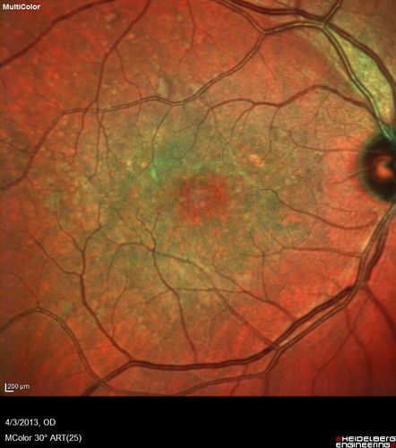Idiopathic Polypoidal Choroidal Vasculopathy - False Color

