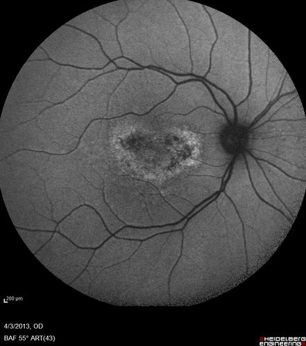 Idiopathic Polypoidal Choroidal Vasculopathy - FAF
