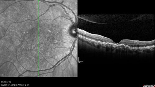 Idiopathic Polypoidal Choroidal Vasculopathy - SD-OCT
