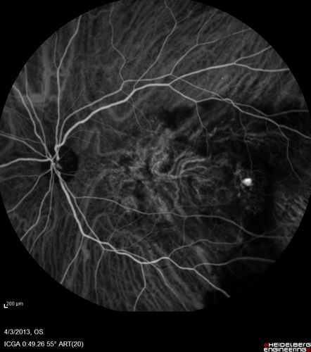 Idiopathic Polypoidal Choroidal Vasculopathy - Indocyanine Green Angiogram - Polyp Visible Left Eye.  Branching Network Both Eye
