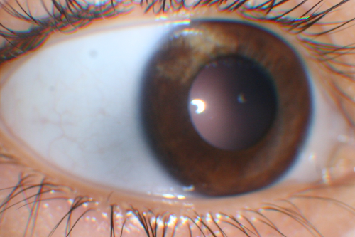 Sectoral Heterochromia Iridum - 3 year old boy
3-year-old child was seen in the office on September 14, 2011.  Since he was an infant a white spot was noticed on the iris in the right eye, it seems to be growing and he comes in because of that. 
