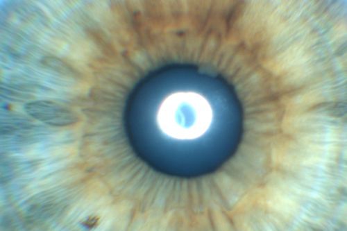 Uveitis - Iris Nodule - Koeppe Nodule
29-year-old woman has had problems with uveitis in the right eye for about the last two years.  Her symptoms are usually floaters.  Occasionally the eye gets red, it has not been very uncomfortable, and it has always been in the right eye.  Has had Iris Nodule like one in photo in left eye and Right eye.  They clear with or without steroids after about a month.
