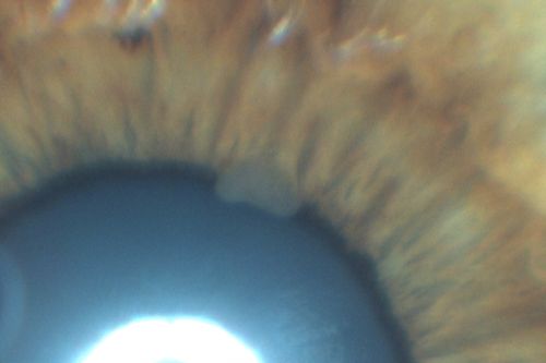 Uveitis - Iris Nodule - Koeppe Nodule
29-year-old woman has had problems with uveitis in the right eye for about the last two years.  Her symptoms are usually floaters.  Occasionally the eye gets red, it has not been very uncomfortable, and it has always been in the right eye.  Has had Iris Nodule like one in photo in left eye and Right eye.  They clear with or without steroids after about a month.
