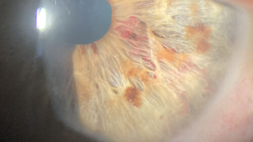 Iris Arteriovenous Malformation
