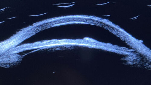 Iris Arteriovenous Malformation

