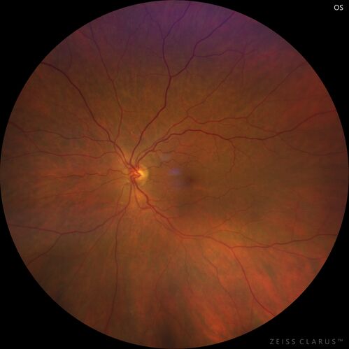 Ocular Ischemia from 100 percent right carotid occlusion
77 year old female the vision in the right eye got much worse.  She has recently been getting more severe headaches.  Her vision is now blank.  She went to her old GP in Wisconsin who said it might be sinus pressure.  Her chiropractor did an adjustment and the chiropractor checked the patient eyes and told her to go to the eye doctor.  She has been feeling pressure around her eye since the air flight.  
Specialty Meds (Initial): systane prn OU. Plavix, Combivent, ASA 325, Vitamin E, Zinc.
PSH â€“ Carotid surgery in 2000 (20 years ago), Stent 11/2022, Mastectomy 2000.
VA OD: DccCF 3ft (eccentric) NccUnable
VA OS: Dcc20/25 NccJ1
IOP: TP: OD:18 OS:16
Psuedophakic OU
Right eye had rubeosis on the pupil margin and not in the angle
Further testing showed 100 percent occlusion of the right carotid artery.  The left carotid artery was stented.
