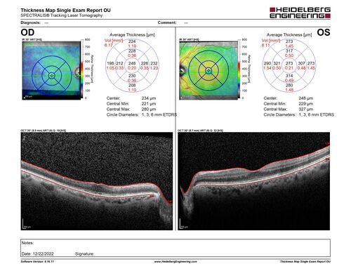 Ocular Ischemia from 100 percent right carotid occlusion
77 year old female the vision in the right eye got much worse.  She has recently been getting more severe headaches.  Her vision is now blank.  She went to her old GP in Wisconsin who said it might be sinus pressure.  Her chiropractor did an adjustment and the chiropractor checked the patient eyes and told her to go to the eye doctor.  She has been feeling pressure around her eye since the air flight.  
Specialty Meds (Initial): systane prn OU. Plavix, Combivent, ASA 325, Vitamin E, Zinc.
PSH â€“ Carotid surgery in 2000 (20 years ago), Stent 11/2022, Mastectomy 2000.
VA OD: DccCF 3ft (eccentric) NccUnable
VA OS: Dcc20/25 NccJ1
IOP: TP: OD:18 OS:16
Psuedophakic OU
Right eye had rubeosis on the pupil margin and not in the angle
Further testing showed 100 percent occlusion of the right carotid artery.  The left carotid artery was stented.

