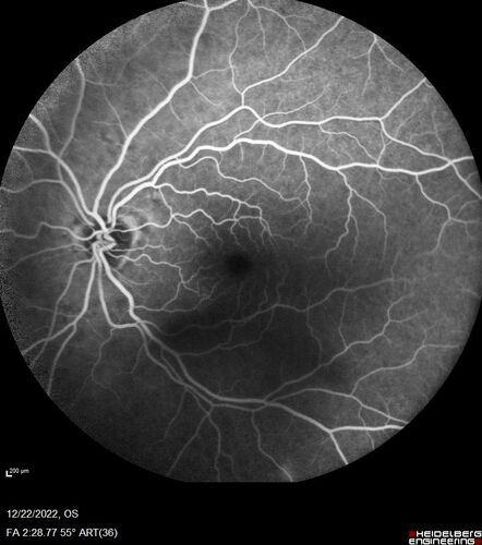 Ocular Ischemia from 100 percent right carotid occlusion
77 year old female the vision in the right eye got much worse.  She has recently been getting more severe headaches.  Her vision is now blank.  She went to her old GP in Wisconsin who said it might be sinus pressure.  Her chiropractor did an adjustment and the chiropractor checked the patient eyes and told her to go to the eye doctor.  She has been feeling pressure around her eye since the air flight.  
Specialty Meds (Initial): systane prn OU. Plavix, Combivent, ASA 325, Vitamin E, Zinc.
PSH â€“ Carotid surgery in 2000 (20 years ago), Stent 11/2022, Mastectomy 2000.
VA OD: DccCF 3ft (eccentric) NccUnable
VA OS: Dcc20/25 NccJ1
IOP: TP: OD:18 OS:16
Psuedophakic OU
Right eye had rubeosis on the pupil margin and not in the angle
Further testing showed 100 percent occlusion of the right carotid artery.  The left carotid artery was stented.
