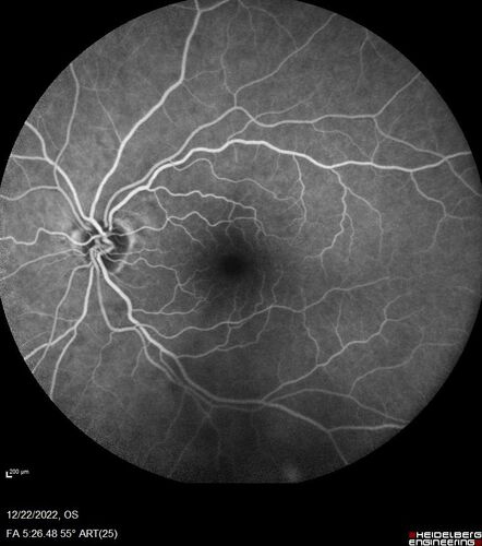 Ocular Ischemia from 100 percent right carotid occlusion
77 year old female the vision in the right eye got much worse.  She has recently been getting more severe headaches.  Her vision is now blank.  She went to her old GP in Wisconsin who said it might be sinus pressure.  Her chiropractor did an adjustment and the chiropractor checked the patient eyes and told her to go to the eye doctor.  She has been feeling pressure around her eye since the air flight.  
Specialty Meds (Initial): systane prn OU. Plavix, Combivent, ASA 325, Vitamin E, Zinc.
PSH â€“ Carotid surgery in 2000 (20 years ago), Stent 11/2022, Mastectomy 2000.
VA OD: DccCF 3ft (eccentric) NccUnable
VA OS: Dcc20/25 NccJ1
IOP: TP: OD:18 OS:16
Psuedophakic OU
Right eye had rubeosis on the pupil margin and not in the angle
Further testing showed 100 percent occlusion of the right carotid artery.  The left carotid artery was stented.
