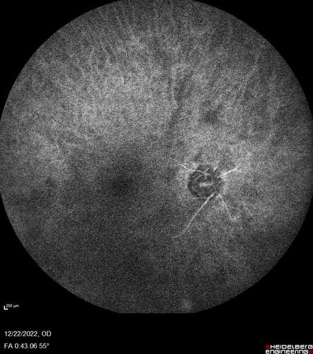 Ocular Ischemia from 100 percent right carotid occlusion
77 year old female the vision in the right eye got much worse.  She has recently been getting more severe headaches.  Her vision is now blank.  She went to her old GP in Wisconsin who said it might be sinus pressure.  Her chiropractor did an adjustment and the chiropractor checked the patient eyes and told her to go to the eye doctor.  She has been feeling pressure around her eye since the air flight.  
Specialty Meds (Initial): systane prn OU. Plavix, Combivent, ASA 325, Vitamin E, Zinc.
PSH â€“ Carotid surgery in 2000 (20 years ago), Stent 11/2022, Mastectomy 2000.
VA OD: DccCF 3ft (eccentric) NccUnable
VA OS: Dcc20/25 NccJ1
IOP: TP: OD:18 OS:16
Psuedophakic OU
Right eye had rubeosis on the pupil margin and not in the angle
Further testing showed 100 percent occlusion of the right carotid artery.  The left carotid artery was stented.
