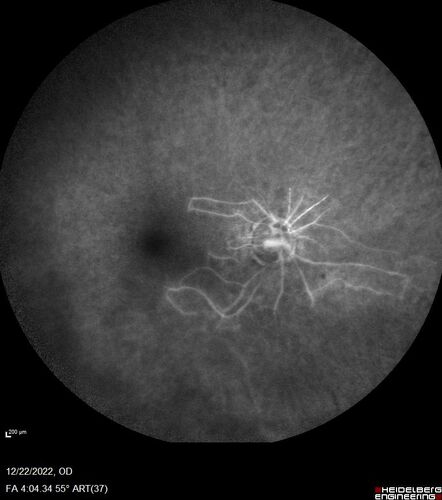Ocular Ischemia from 100 percent right carotid occlusion
77 year old female the vision in the right eye got much worse.  She has recently been getting more severe headaches.  Her vision is now blank.  She went to her old GP in Wisconsin who said it might be sinus pressure.  Her chiropractor did an adjustment and the chiropractor checked the patient eyes and told her to go to the eye doctor.  She has been feeling pressure around her eye since the air flight.  
Specialty Meds (Initial): systane prn OU. Plavix, Combivent, ASA 325, Vitamin E, Zinc.
PSH â€“ Carotid surgery in 2000 (20 years ago), Stent 11/2022, Mastectomy 2000.
VA OD: DccCF 3ft (eccentric) NccUnable
VA OS: Dcc20/25 NccJ1
IOP: TP: OD:18 OS:16
Psuedophakic OU
Right eye had rubeosis on the pupil margin and not in the angle
Further testing showed 100 percent occlusion of the right carotid artery.  The left carotid artery was stented.
