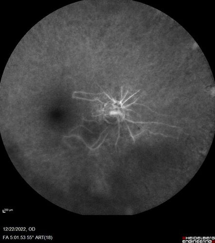 Ocular Ischemia from 100 percent right carotid occlusion
77 year old female the vision in the right eye got much worse.  She has recently been getting more severe headaches.  Her vision is now blank.  She went to her old GP in Wisconsin who said it might be sinus pressure.  Her chiropractor did an adjustment and the chiropractor checked the patient eyes and told her to go to the eye doctor.  She has been feeling pressure around her eye since the air flight.  
Specialty Meds (Initial): systane prn OU. Plavix, Combivent, ASA 325, Vitamin E, Zinc.
PSH â€“ Carotid surgery in 2000 (20 years ago), Stent 11/2022, Mastectomy 2000.
VA OD: DccCF 3ft (eccentric) NccUnable
VA OS: Dcc20/25 NccJ1
IOP: TP: OD:18 OS:16
Psuedophakic OU
Right eye had rubeosis on the pupil margin and not in the angle
Further testing showed 100 percent occlusion of the right carotid artery.  The left carotid artery was stented.
