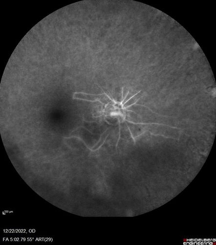 Ocular Ischemia from 100 percent right carotid occlusion
77 year old female the vision in the right eye got much worse.  She has recently been getting more severe headaches.  Her vision is now blank.  She went to her old GP in Wisconsin who said it might be sinus pressure.  Her chiropractor did an adjustment and the chiropractor checked the patient eyes and told her to go to the eye doctor.  She has been feeling pressure around her eye since the air flight.  
Specialty Meds (Initial): systane prn OU. Plavix, Combivent, ASA 325, Vitamin E, Zinc.
PSH â€“ Carotid surgery in 2000 (20 years ago), Stent 11/2022, Mastectomy 2000.
VA OD: DccCF 3ft (eccentric) NccUnable
VA OS: Dcc20/25 NccJ1
IOP: TP: OD:18 OS:16
Psuedophakic OU
Right eye had rubeosis on the pupil margin and not in the angle
Further testing showed 100 percent occlusion of the right carotid artery.  The left carotid artery was stented.
