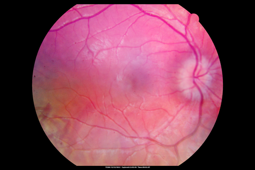 Papilledema - Spectral Domain OCT used for Diagnosis - 14 year old Child
14-year-old was with optic nerve swelling asymptomatic - picked up during routine eye exam.  OD 20/20,  OS 20/32
SD-OCT is used to differentiate optic disc edema from optic nerve head drusen (which are not yet calcified in children).
