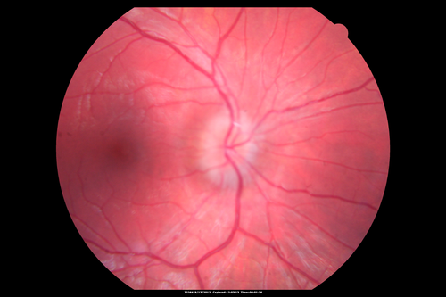 Papilledema - Spectral Domain OCT used for Diagnosis - 14 year old Child
14-year-old was with optic nerve swelling asymptomatic - picked up during routine eye exam.  OD 20/20,  OS 20/32
SD-OCT is used to differentiate optic disc edema from optic nerve head drusen (which are not yet calcified in children).
