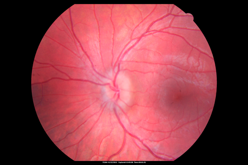 Papilledema - Spectral Domain OCT used for Diagnosis - 14 year old Child
14-year-old was with optic nerve swelling asymptomatic - picked up during routine eye exam.  OD 20/20,  OS 20/32
SD-OCT is used to differentiate optic disc edema from optic nerve head drusen (which are not yet calcified in children).

