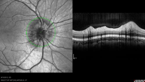 Papilledema - Spectral Domain OCT used for Diagnosis - 14 year old Child  - Nerve Fiber Layer Scan shows swelling
14-year-old was with optic nerve swelling asymptomatic - picked up during routine eye exam.  OD 20/20,  OS 20/32
SD-OCT is used to differentiate optic disc edema from optic nerve head drusen (which are not yet calcified in children).
