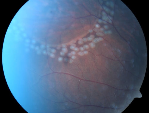 Asymptomatic Retinal Detachment Confirmed with Optical Coherence Tomography (OCT)
24-year-old 20/20 vision in each eye.  Patient referred for retinoschisis.  OCT confirmed retinal detachment.  Patient is very active and in military so the detachment was treated with laser demarcation.

