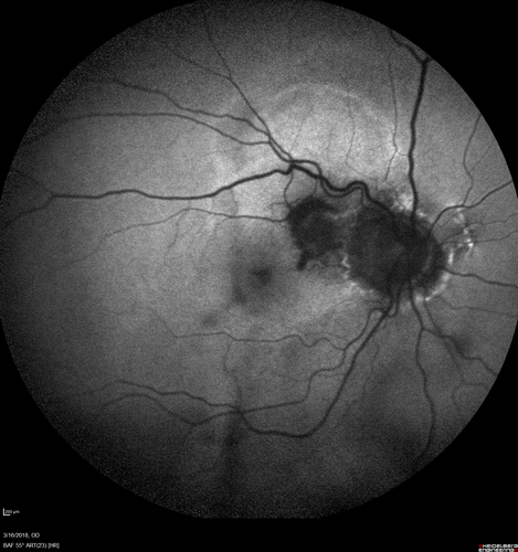 Juxtapapillary CNVM - Hemorrhage
83 year old female VA 20/200 improved to 20/32 within 2 months with Lucentis

